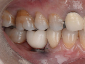 【歯科医が認めるインプラント治療】九州の歯科医がインプラントオペの患者として来院されました。