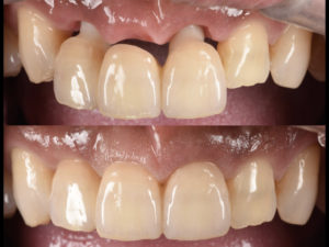 見た目の悪いブリッジをインプラントで改善【前歯部審美症例2】