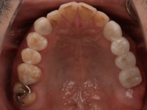 【骨が足りない時のインプラント治療①】