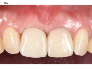 前歯が折れた後のインプラント治療【前歯部審美症例3】