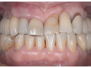 他院のインプラントと当院のインプラントの比較【前歯部審美症例4】