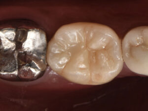 最新の機械(光学印象)でインプラントの補綴物を作った症例