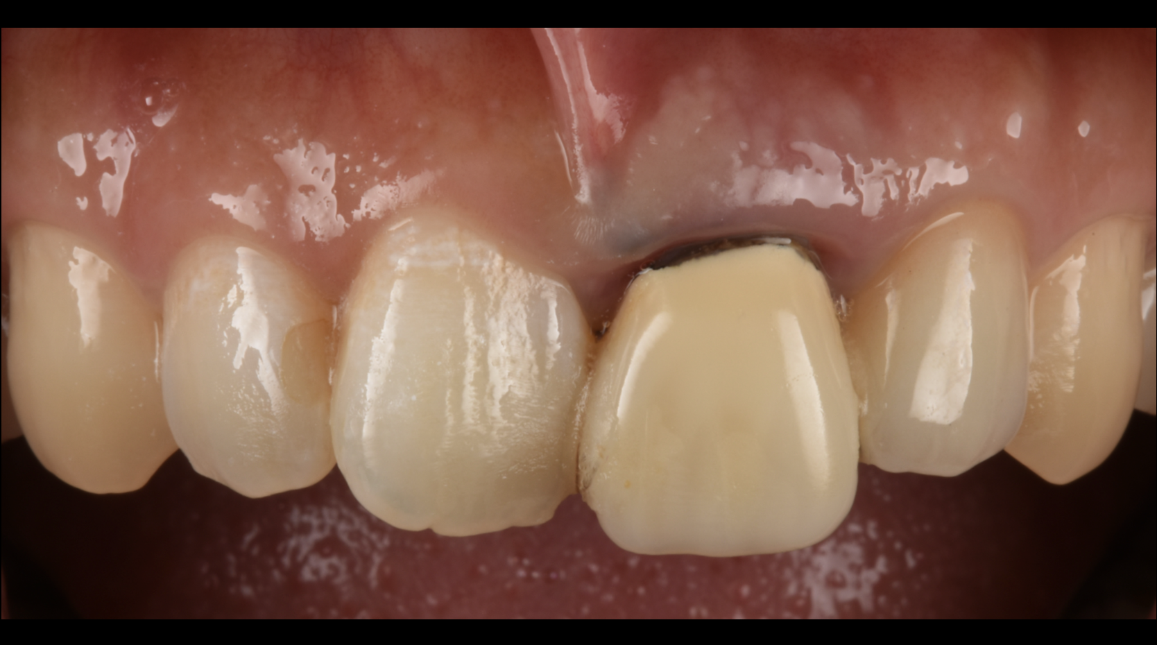 土台ごと折れた前歯をインプラントで治療した症例【前歯部審美症例12】