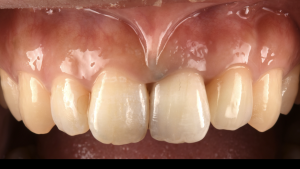 土台ごと折れた前歯をインプラントで治療した症例【前歯部審美症例12】