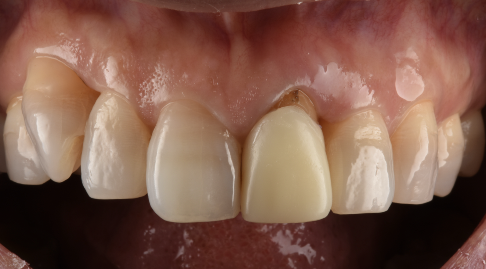 根が縦に割れてしまった前歯をインプラントで治療した症例【前歯部審美症例13】