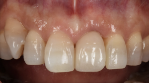 根が縦に割れてしまった前歯をインプラントで治療した症例【前歯部審美症例13】