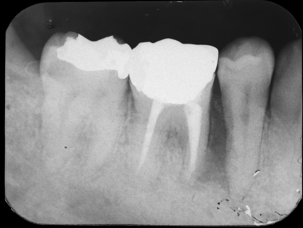 根が折れて骨が吸収した奥歯をインプラントで治療した症例