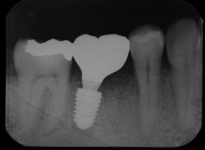根が折れて骨が吸収した奥歯をインプラントで治療した症例