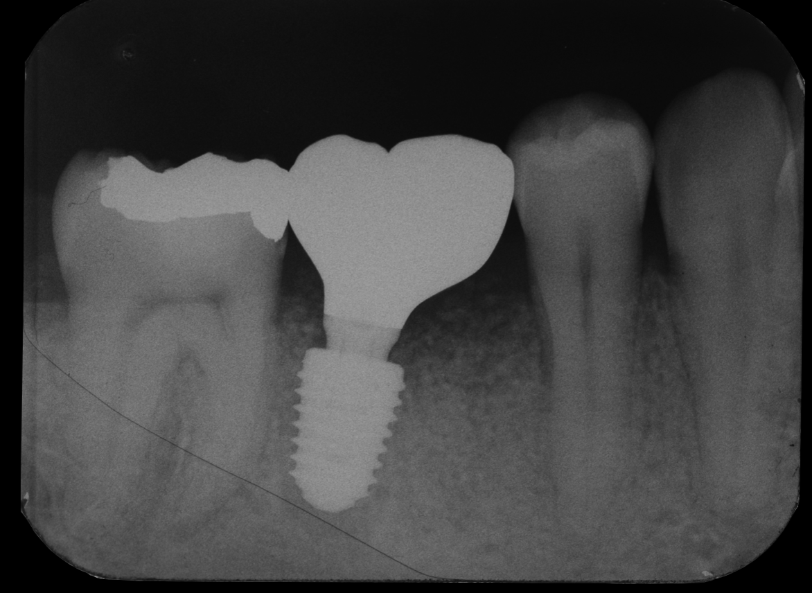 根が折れて骨が吸収した奥歯をインプラントで治療した症例