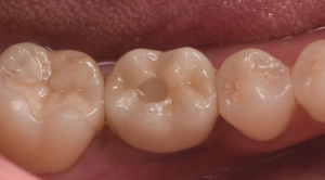 根が折れた奥歯をインプラントで治療した症例