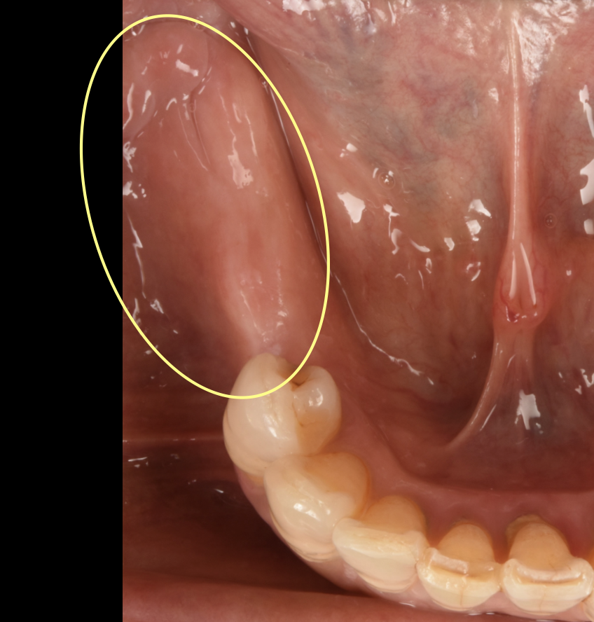 奥歯にインプラントを入れてしっかり噛めるようになった症例