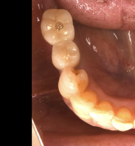 奥歯にインプラントを入れてしっかり噛めるようになった症例