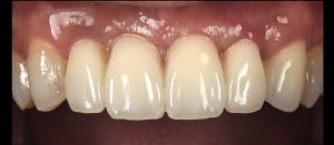 前歯複数本をインプラントで再建した症例【前歯部審美症例9】
