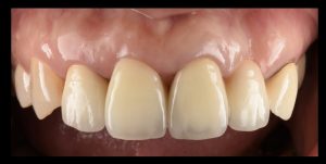 折れた前歯のインプラント治療【前歯部審美症例8】