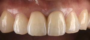 前歯の歯根が折れた【前歯部審美症例17】