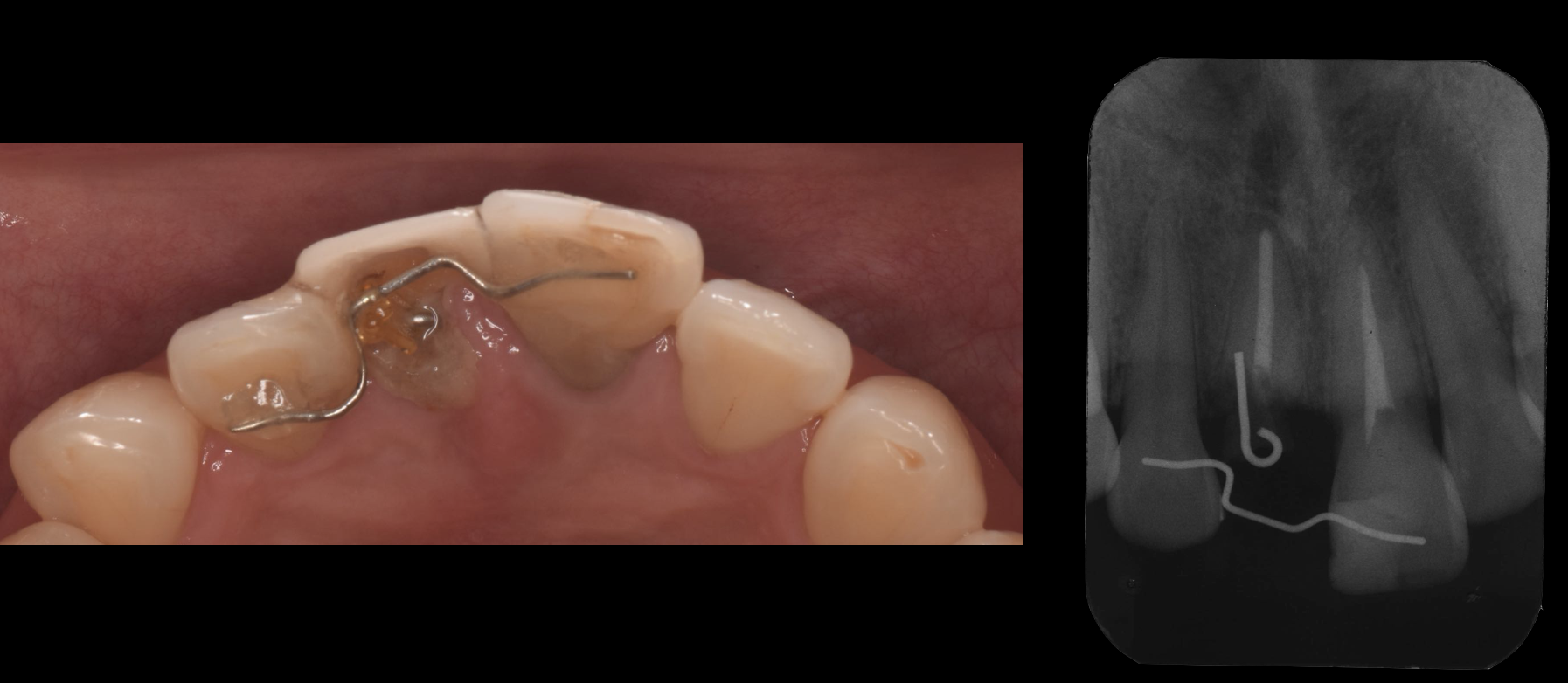 前歯の歯根が折れた【前歯部審美症例17】 │治療部位・種類別に見る