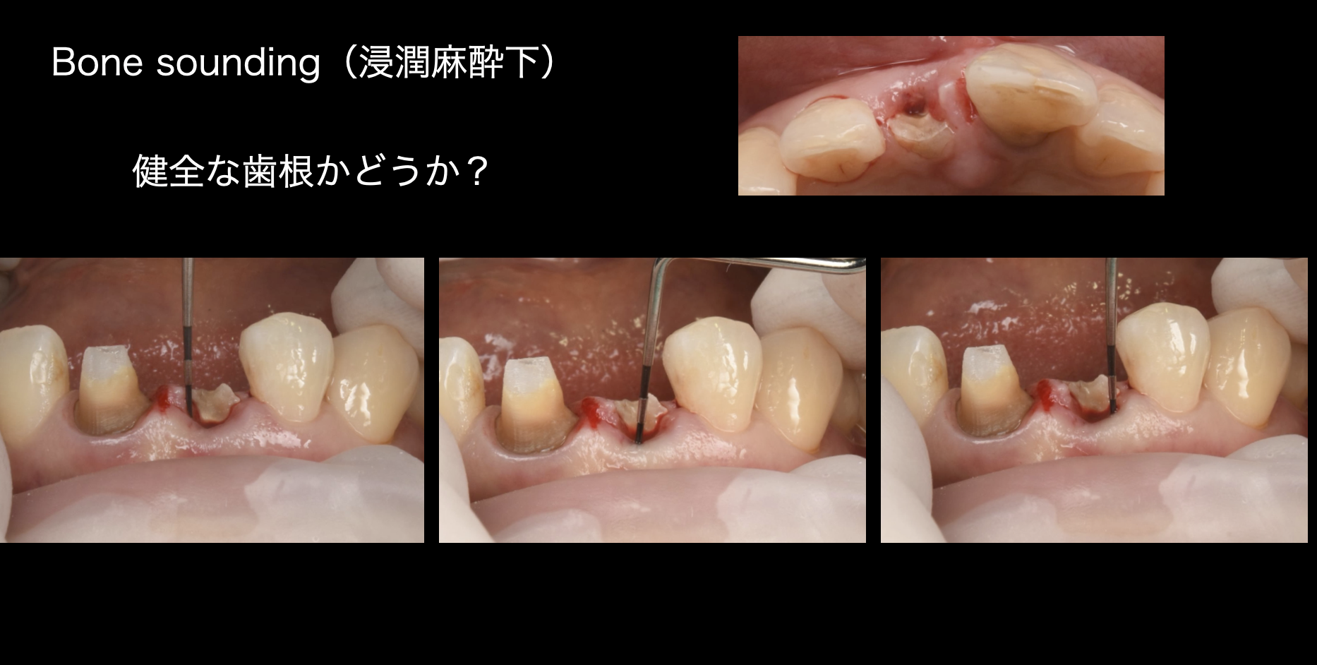 前歯の歯根が折れた【前歯部審美症例17】 │治療部位・種類別に見る