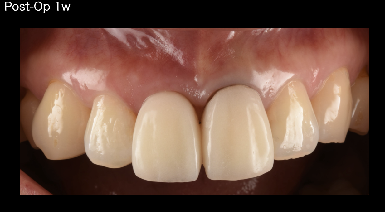 前歯の歯根が折れた【前歯部審美症例17】 │治療部位・種類別に見る