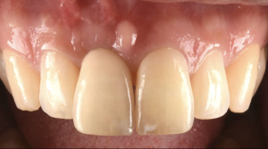 前歯の腫れで来院【前歯部審美症例16】