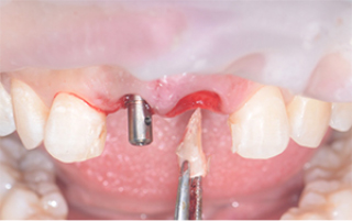 歯ぐきの形状を維持する「ルート・メンブレン・テクニック」