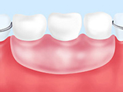 入れ歯（保険適用の場合）