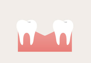 例えば、右下の６歳臼歯を失ったまま放置するとします。
