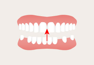 残るは前歯だけになり、下の前歯が上の前歯を突き上げ、その力で前歯が壊れてしまいます。