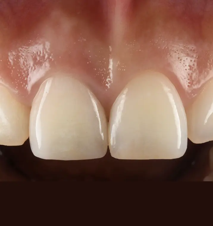 天然の歯?なかやま歯科の美しさにこだわるインプラント治療