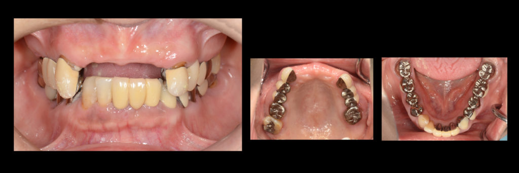 噛めないお口を歯ぐきを切らないインプラントで短期間に治療！【国際シンポジウムでの講演症例】