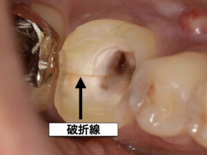 噛む力により割れた大臼歯をインプラントで治療した症例