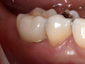保存不可能な奥歯をインプラントで治療した症例