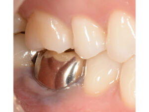 根っこが折れた奥歯をインプラントで治療した症例