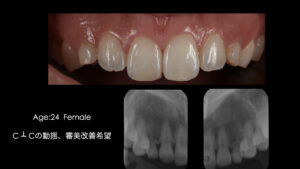 乳歯の晩期残存歯をインプラントで再建した症例【前歯部審美症例７】