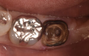 根の虫歯で抜歯になった下顎の奥歯をインプラントで再建した症例