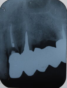 大きな虫歯と根の破折で抜歯適応となった歯を複数本インプラントで再建した症例