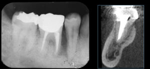 根が折れて骨が吸収した奥歯をインプラントで治療した症例