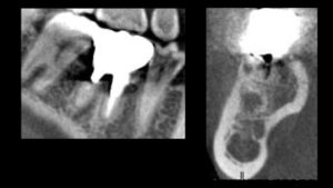 根が折れた奥歯をインプラントで治療した症例